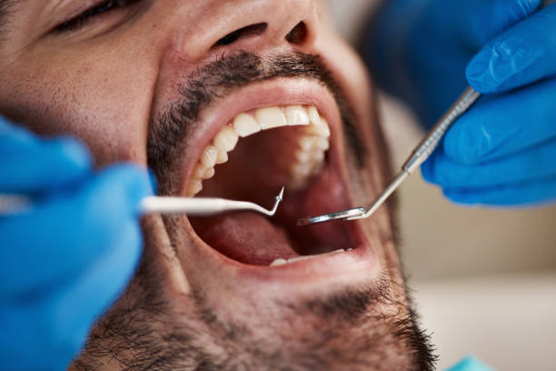 Best Emergency Dentist for Lost Fillings or Crowns in New Mford, IL